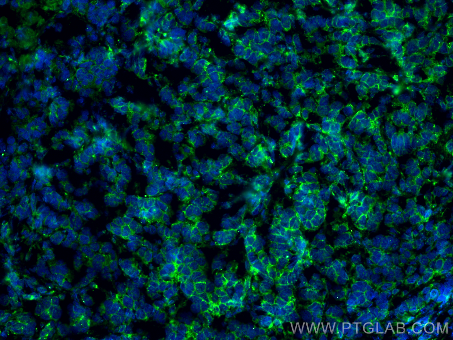 IF Staining of mouse breast cancer using 60335-1-Ig