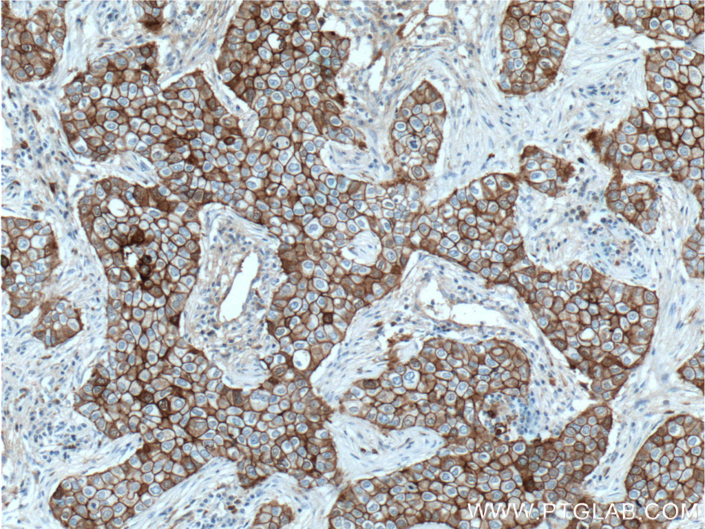 IHC staining of human breast cancer using 60335-1-Ig (same clone as 60335-1-PBS)