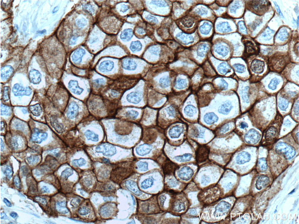 IHC staining of human breast cancer using 60335-1-Ig (same clone as 60335-1-PBS)