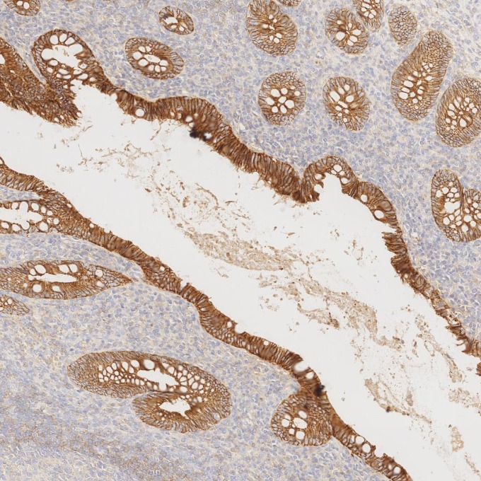 IHC staining of human appendicitis using 60335-1-Ig