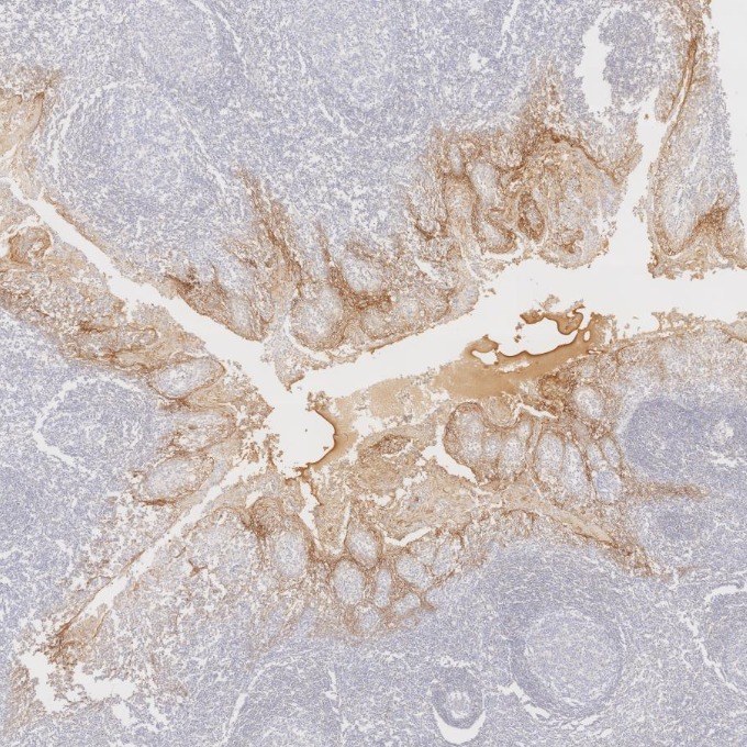 IHC staining of human tonsillitis using 60335-1-Ig