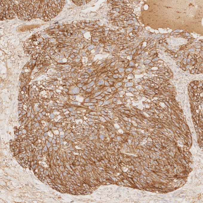 IHC staining of human ovary cancer using 60335-1-Ig