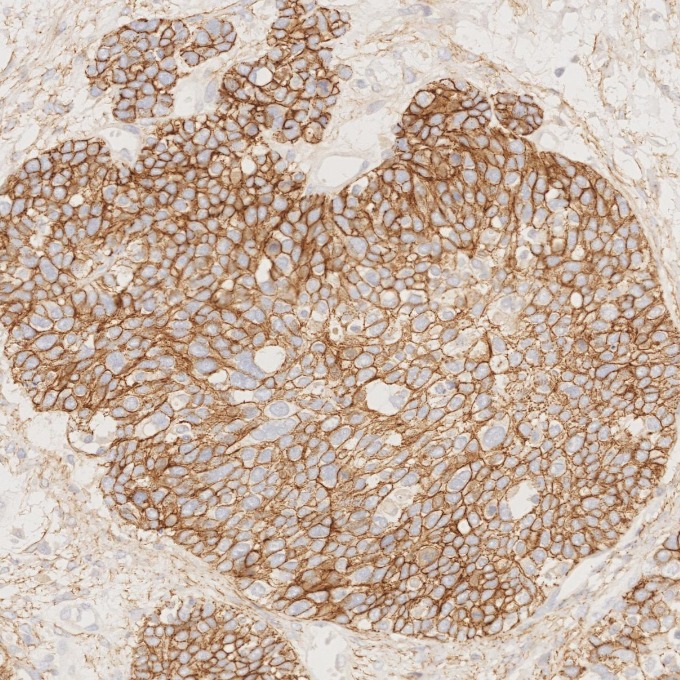 IHC staining of human ovary cancer using 60335-1-Ig