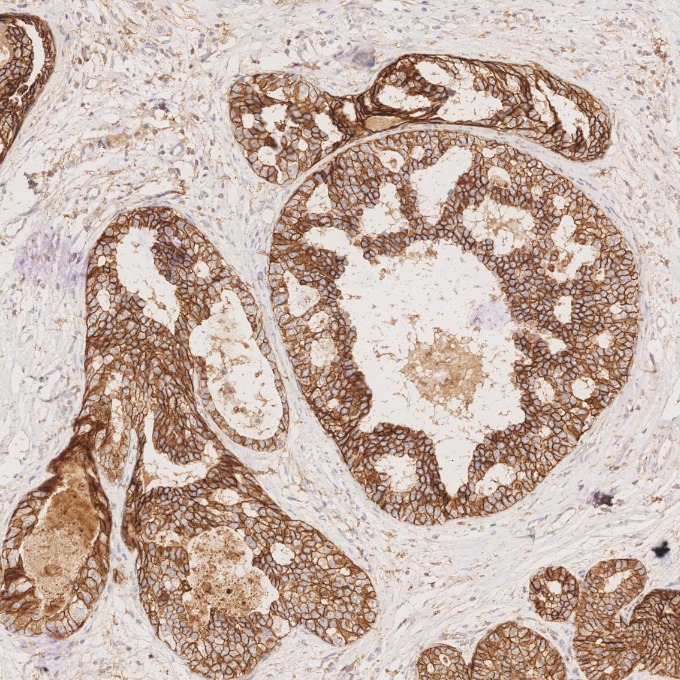 IHC staining of human breast cancer using 60335-1-Ig