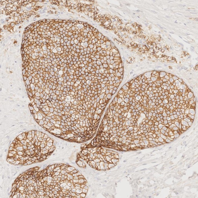 IHC staining of human breast cancer using 60335-1-Ig