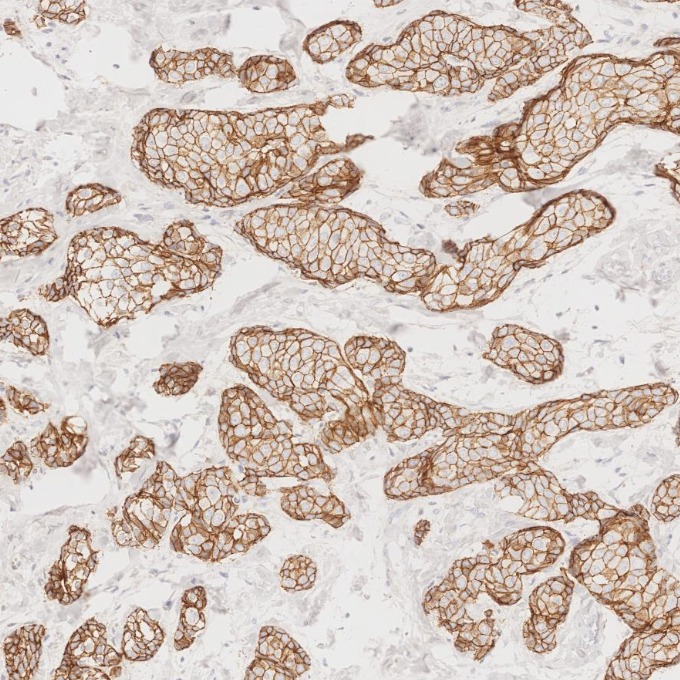 IHC staining of human breast cancer using 60335-1-Ig
