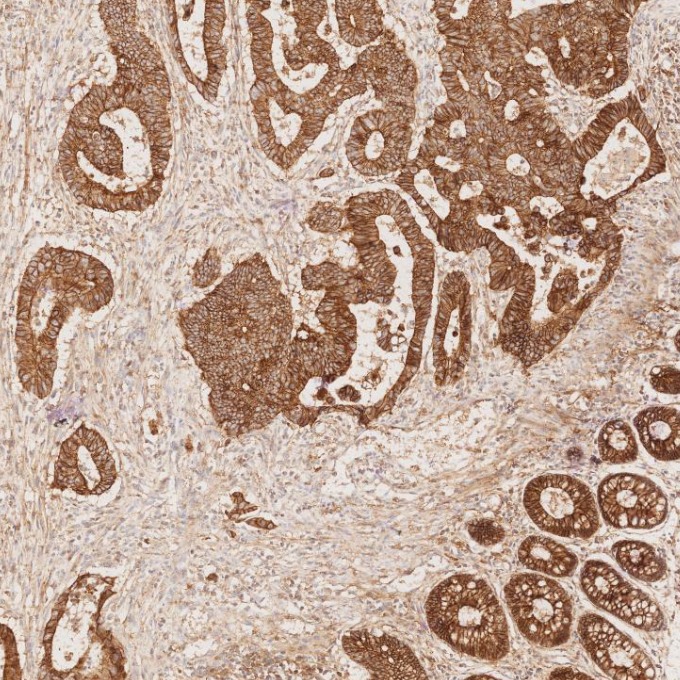 IHC staining of human colorectal cancer using 60335-1-Ig