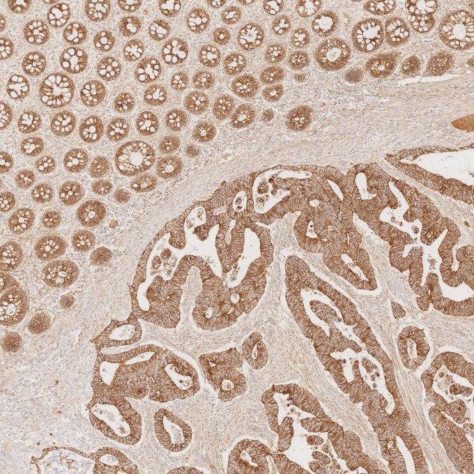 IHC staining of human colorectal cancer using 60335-1-Ig
