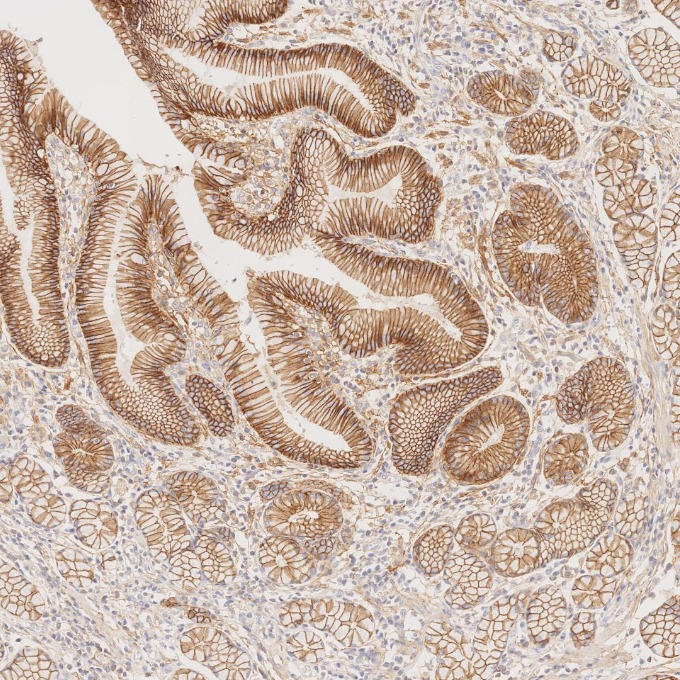 IHC staining of human stomach cancer using 60335-1-Ig