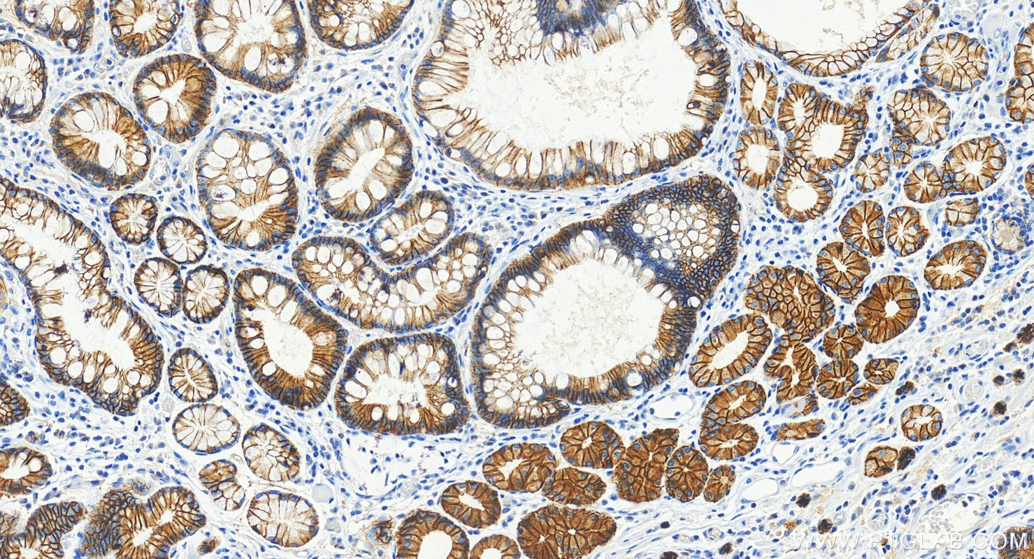 IHC staining of human stomach cancer using 60902-1-Ig (same clone as 60902-1-PBS)