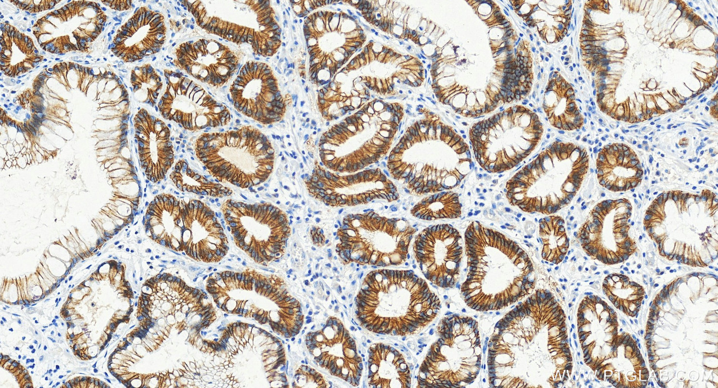 IHC staining of human stomach cancer using 60902-1-Ig (same clone as 60902-1-PBS)