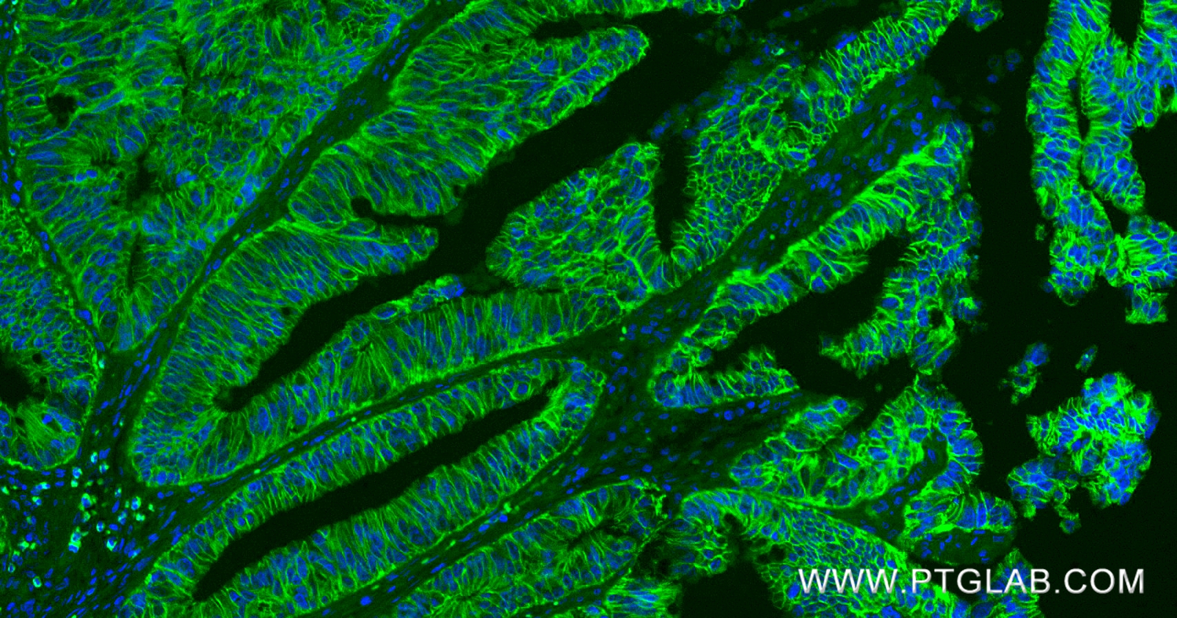 Immunofluorescent analysis of (4% PFA) fixed paraffin-embedded human colon cancer tissue using E-cadherin antibody (80541-7-RR, Clone: 240159A1 ) at dilution of 1:400 and CoraLite®488-Conjugated Goat Anti-Rabbit IgG(H+L) (<a class='green' href='/productredirect?CatalogNo=SA00013-2' target='_blank'>SA00013-2</a>). Heat mediated antigen retrieval with Tris-EDTA buffer (pH 9.0). IF Staining of human colon cancer using 80541-7-RR