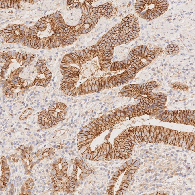 IHC staining of human stomach cancer using 83991-4-RR IHC staining of human stomach cancer using 83991-4-RR