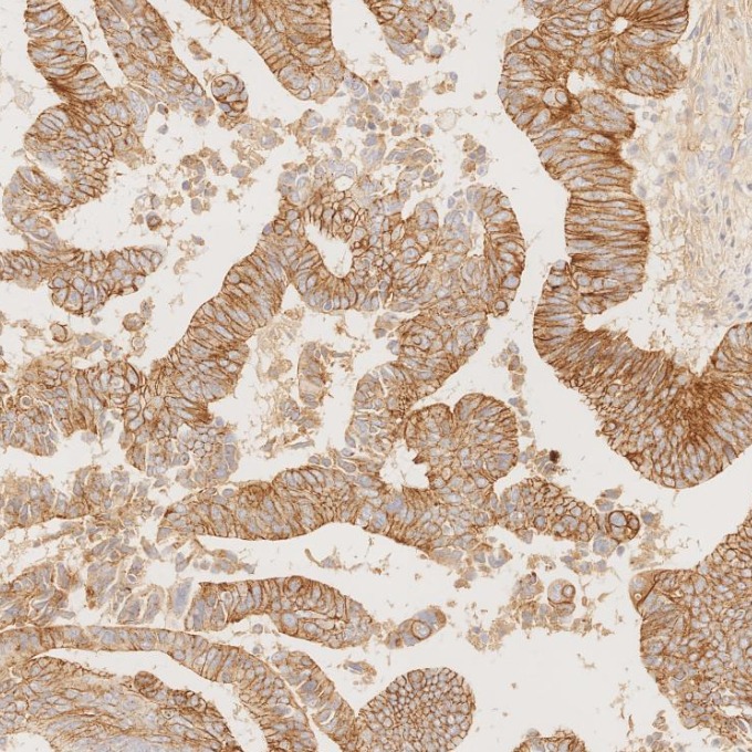 IHC staining of human colorectal cancer using 83991-4-RR IHC staining of human colorectal cancer using 83991-4-RR