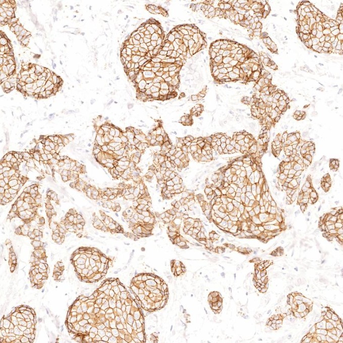 IHC staining of human breast cancer using 83991-4-RR IHC staining of human breast cancer using 83991-4-RR