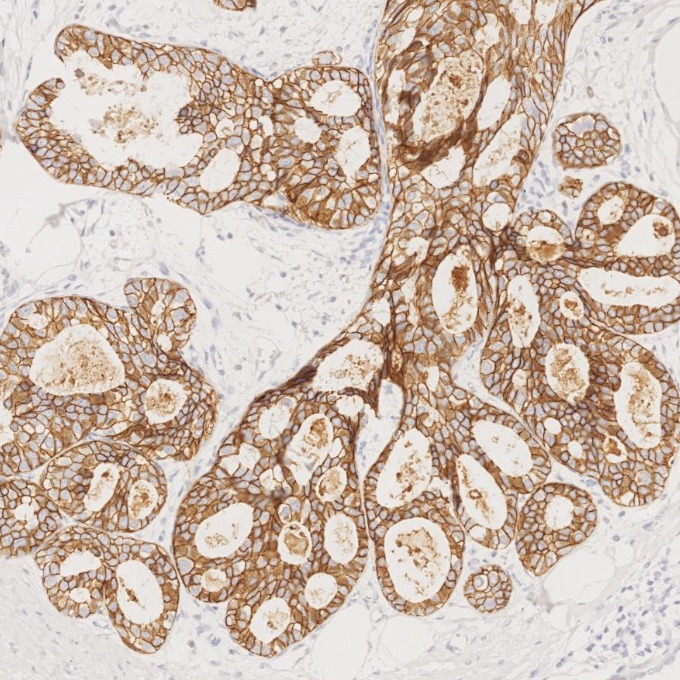IHC staining of human breast cancer using 83991-4-RR IHC staining of human breast cancer using 83991-4-RR