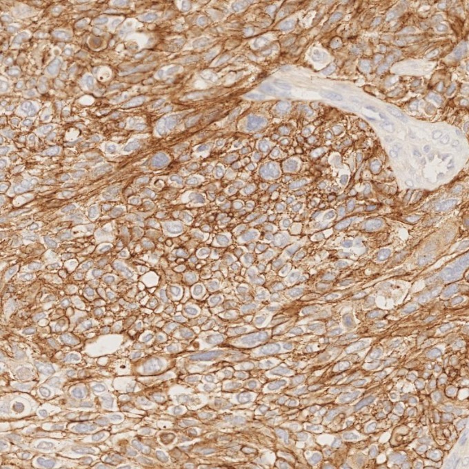 IHC staining of human ovary cancer using 83991-4-RR IHC staining of human ovary cancer using 83991-4-RR