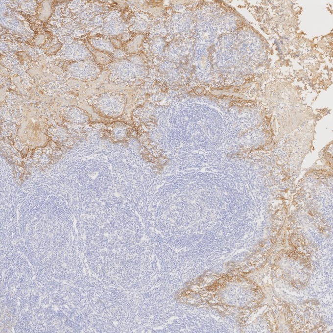 IHC staining of human tonsillitis using 83991-4-RR IHC staining of human tonsillitis using 83991-4-RR