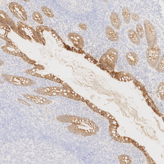 IHC staining of human appendicitis using 83991-4-RR IHC staining of human appendicitis using 83991-4-RR