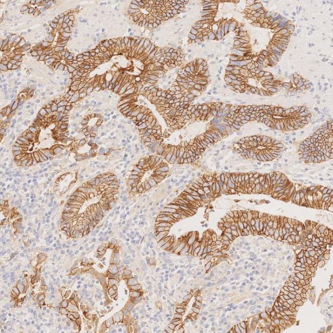 IHC staining of human stomach cancer using 83991-4-RR IHC staining of human stomach cancer using 83991-4-RR