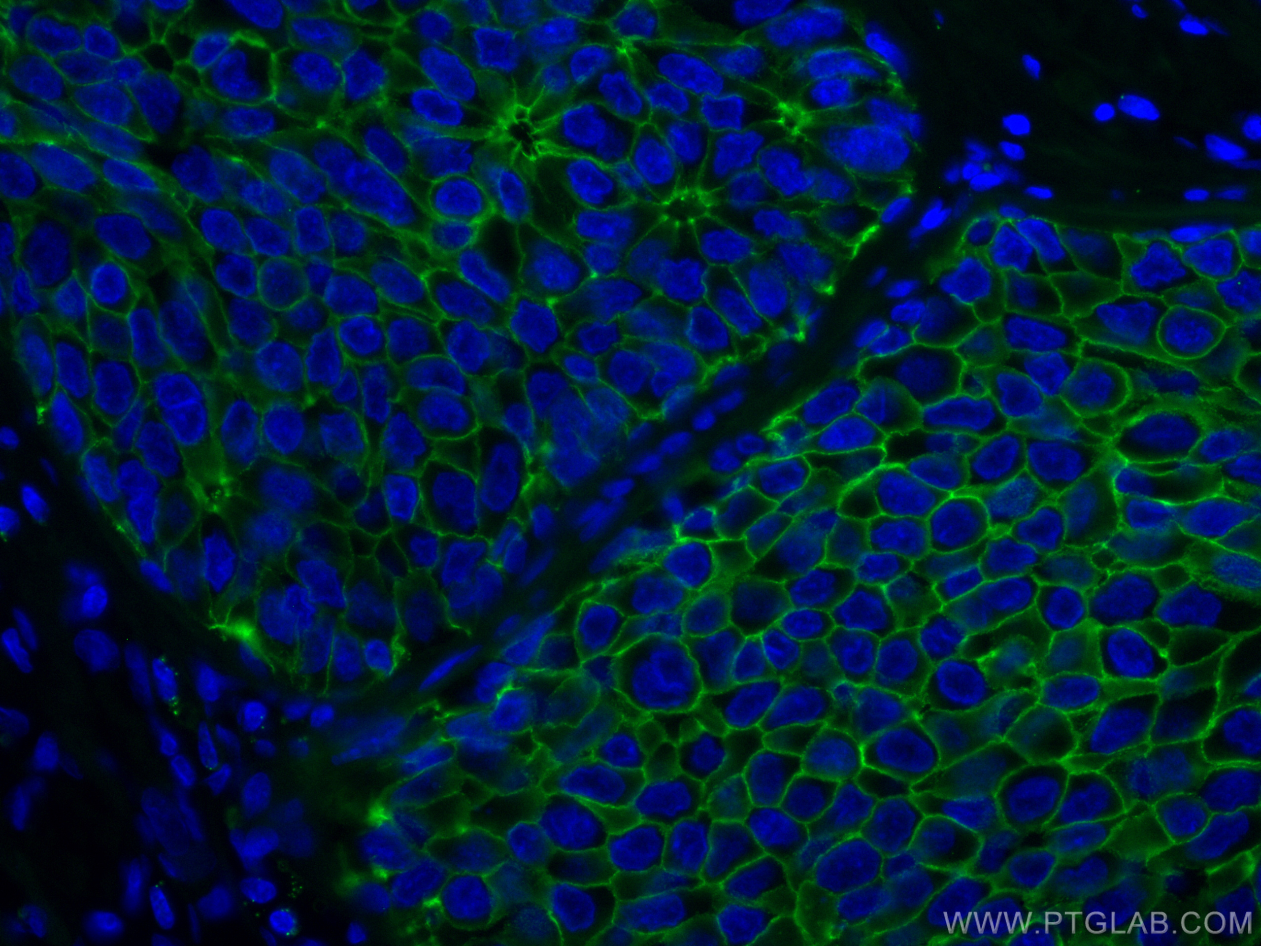 IF Staining of human breast cancer using CL488-60335