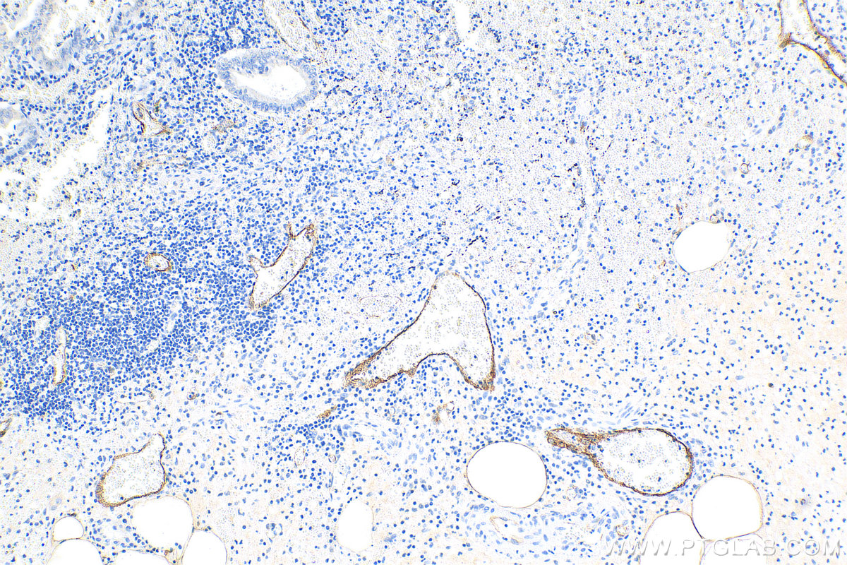 IHC staining of human appendicitis using 30205-1-AP