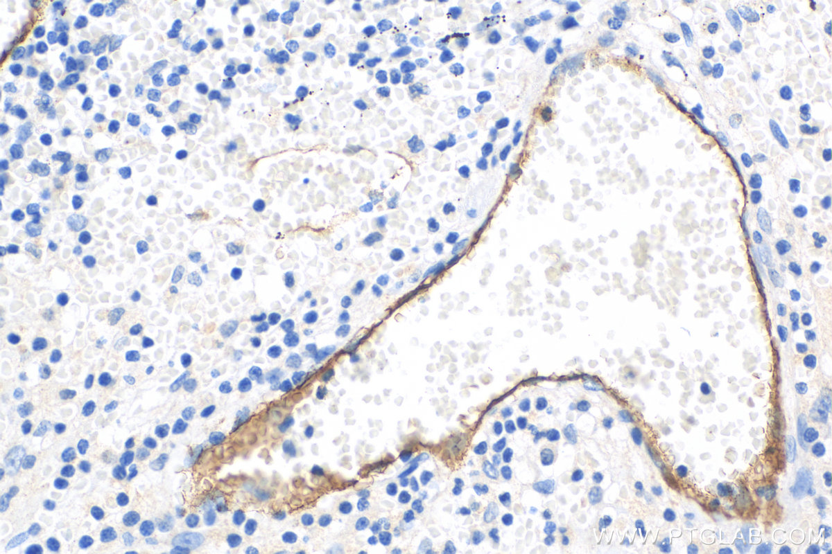 IHC staining of human appendicitis using 30205-1-AP