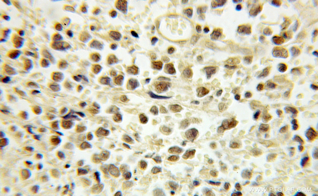 IHC staining of human lymphoma using 10923-1-AP