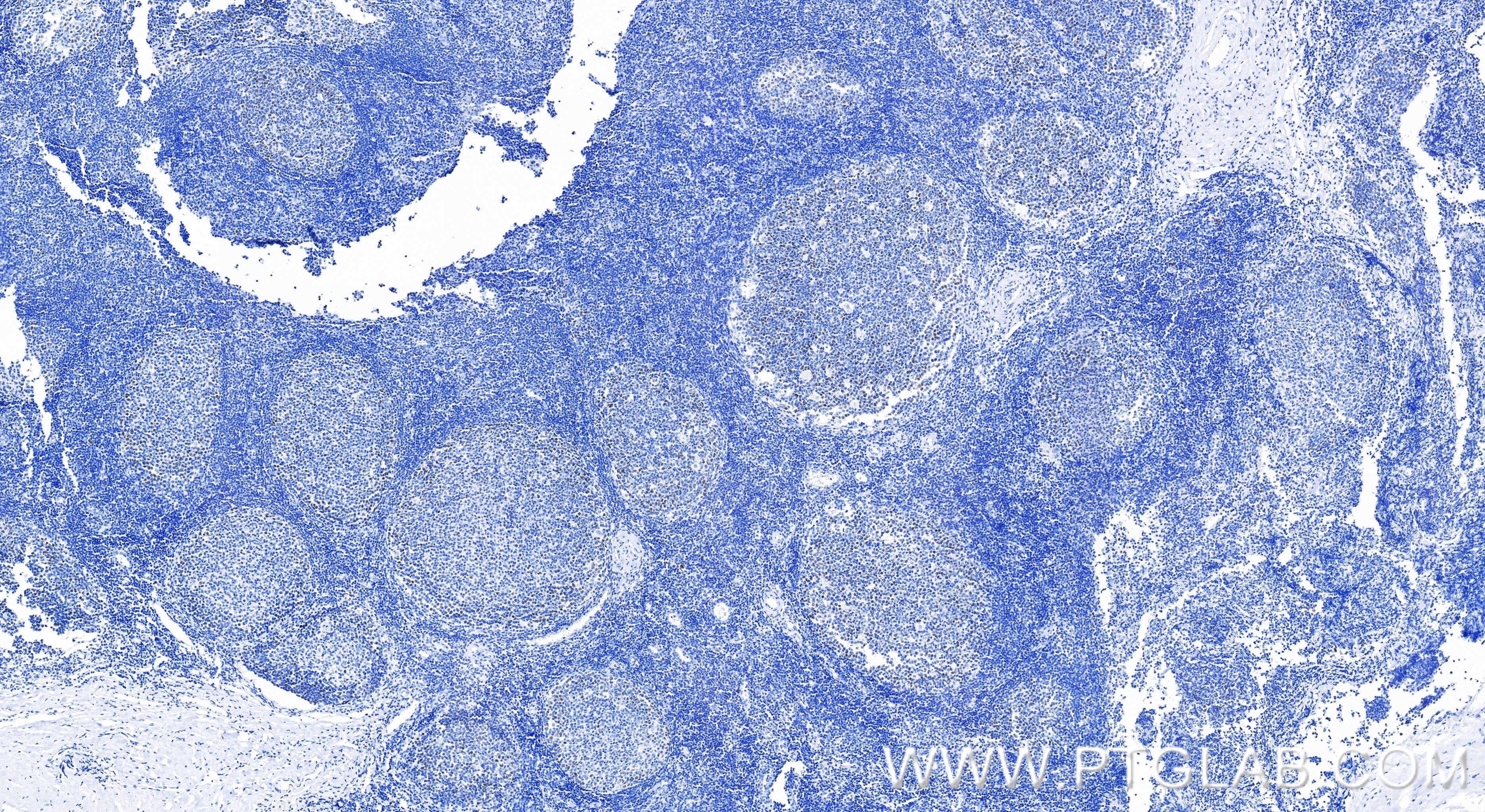IHC staining of human tonsillitis using 86645-1-RR IHC staining of human tonsillitis using 86645-1-RR
