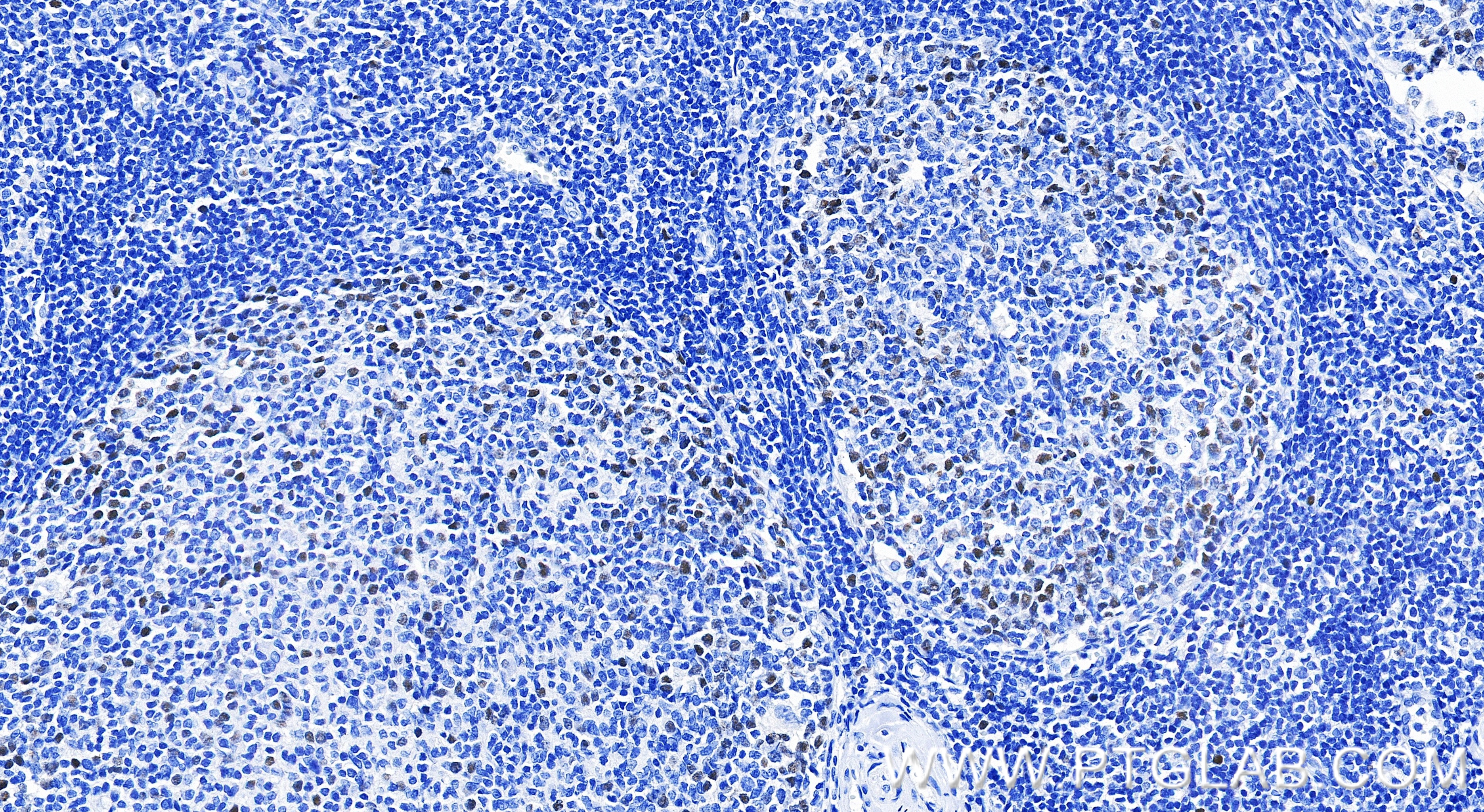 IHC staining of human tonsillitis using 86645-1-RR IHC staining of human tonsillitis using 86645-1-RR