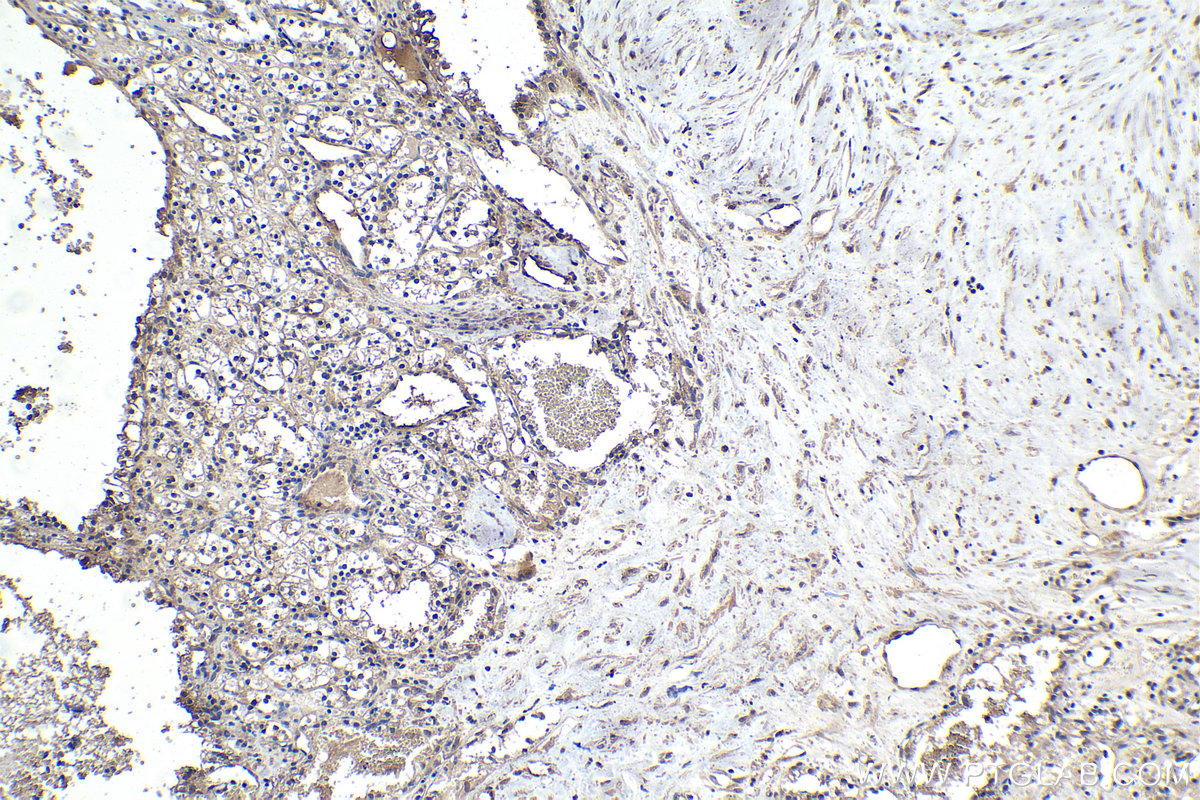 IHC staining of human renal cell carcinoma using 67179-1-Ig