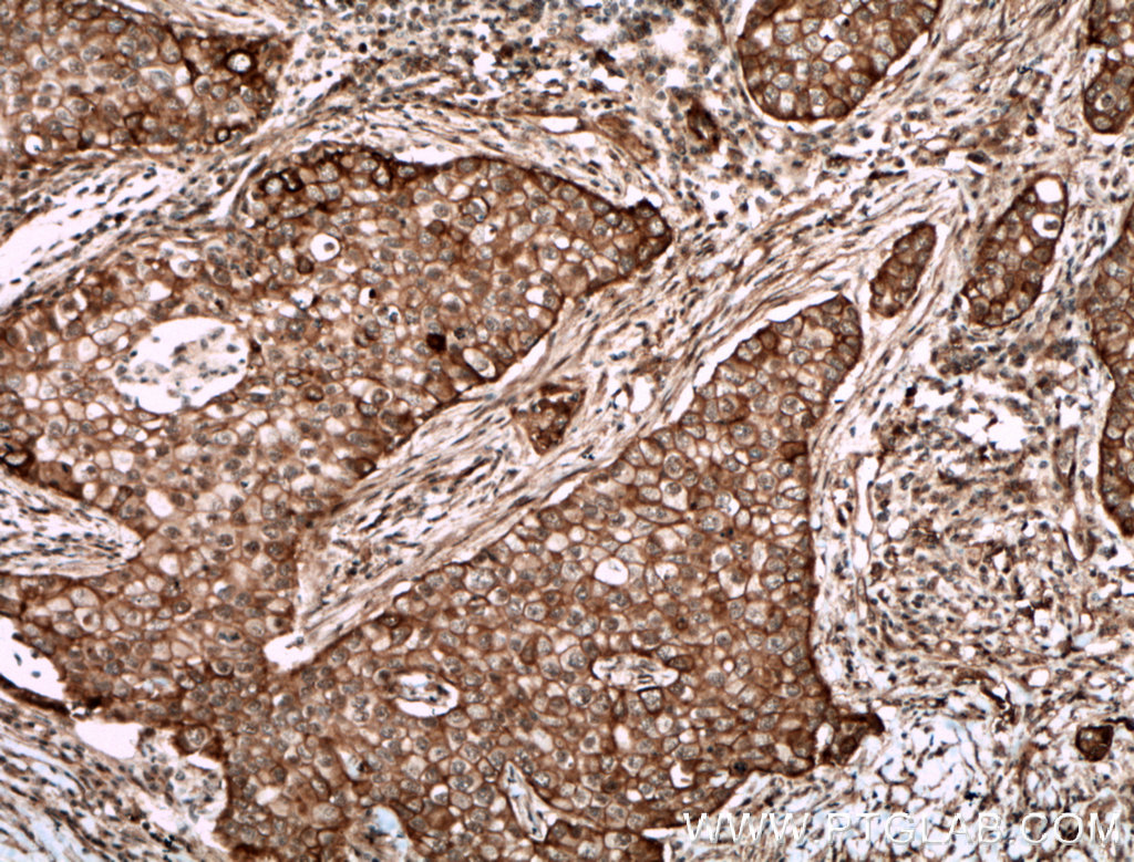 IHC staining of human breast cancer using 26088-1-AP