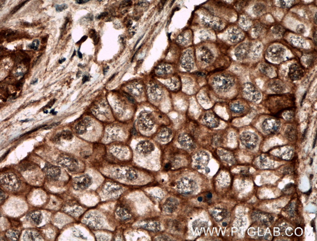 IHC staining of human breast cancer using 26088-1-AP