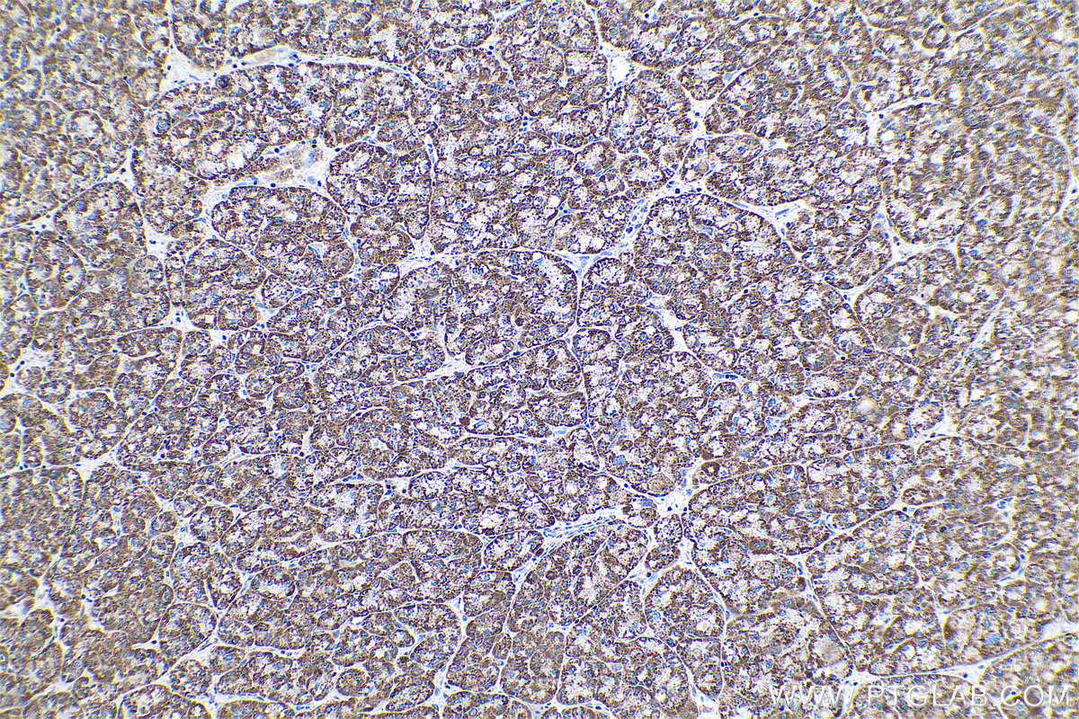 IHC staining of human liver cancer using 68139-1-Ig