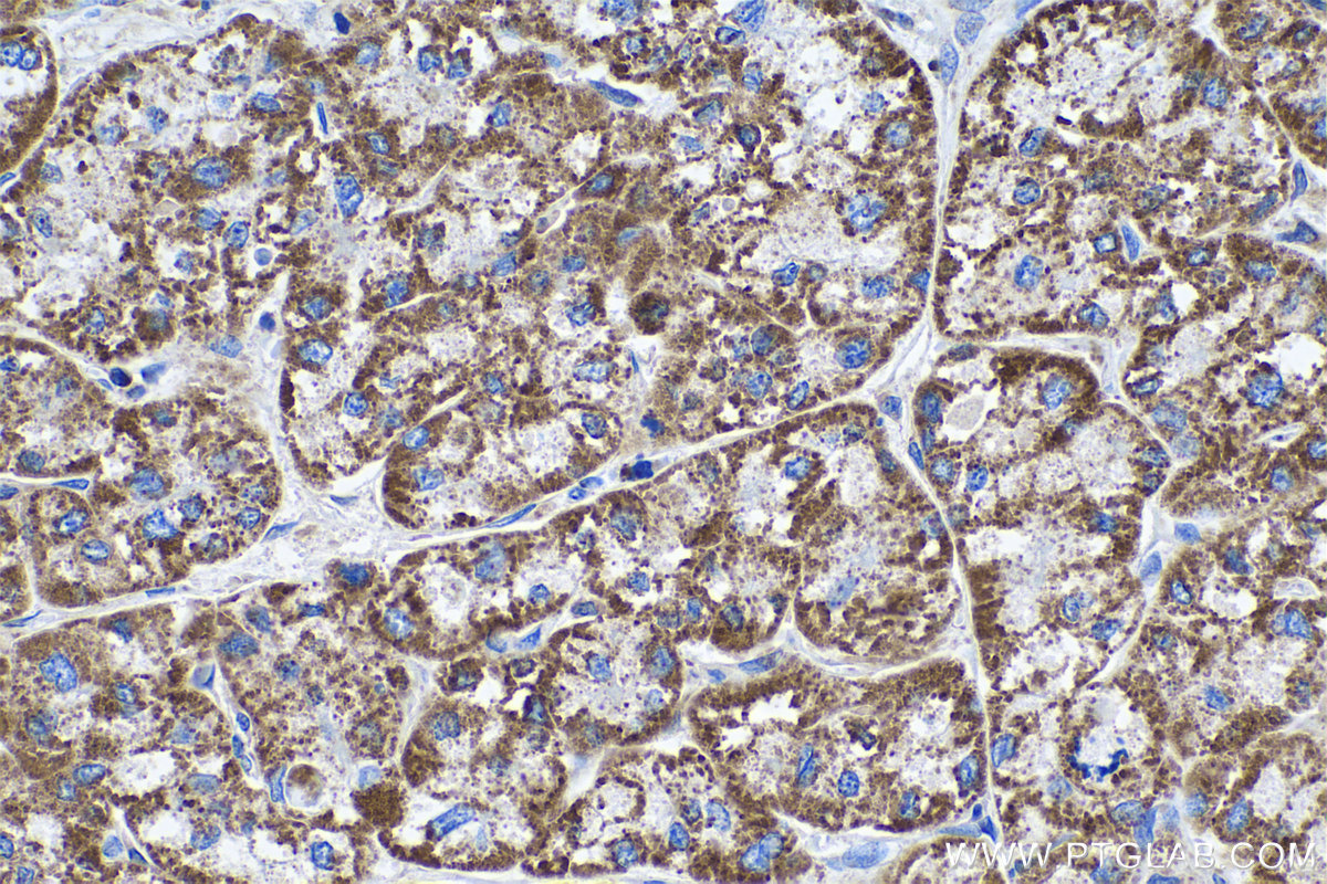 IHC staining of human liver cancer using 68139-1-Ig