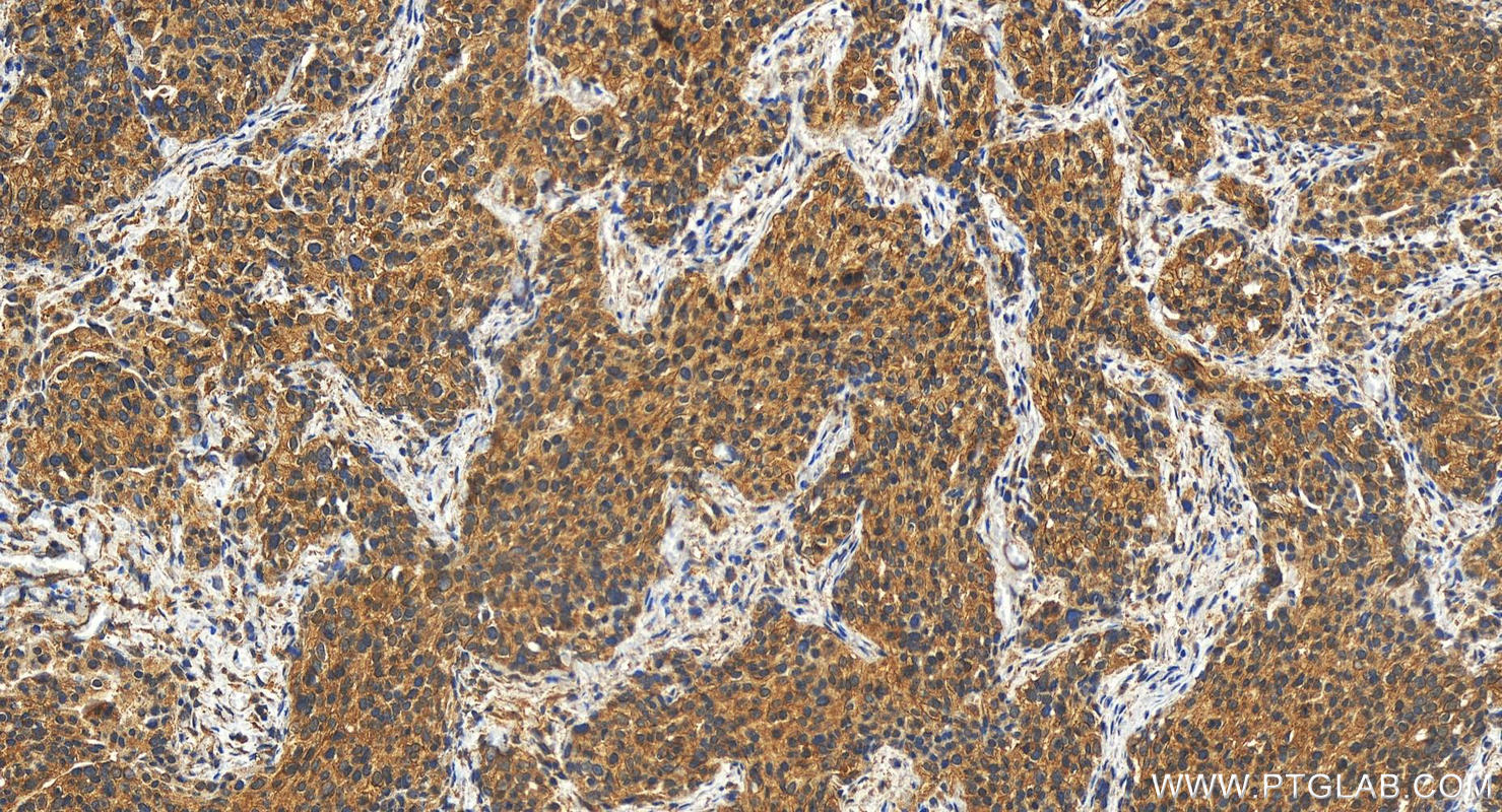 IHC staining of human ovary cancer using 27098-1-AP