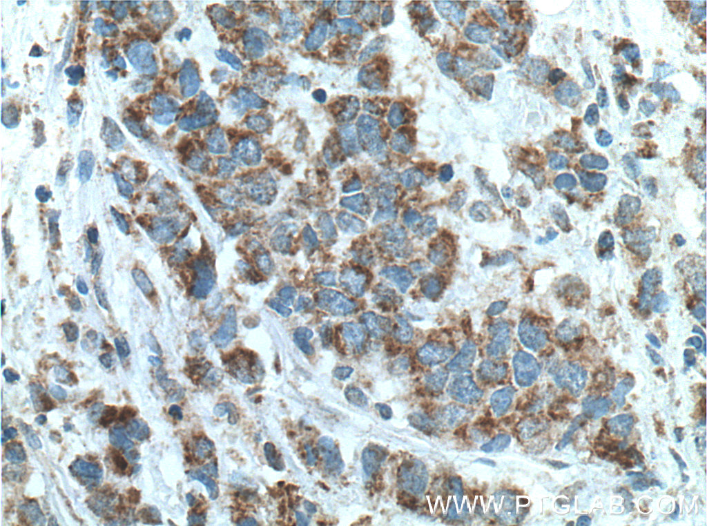 IHC staining of human prostate cancer using 66117-1-Ig (same clone as 66117-1-PBS)