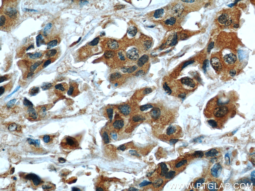 IHC staining of human breast cancer using 66023-1-Ig