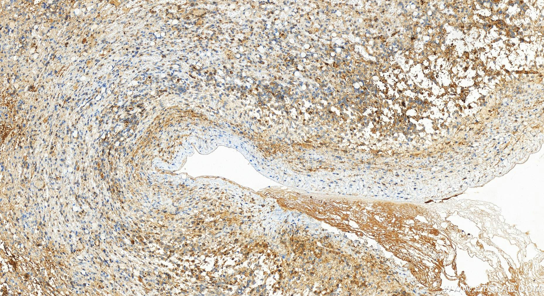 IHC staining of human ovary cancer using 83295-1-RR (same clone as 83295-1-PBS)