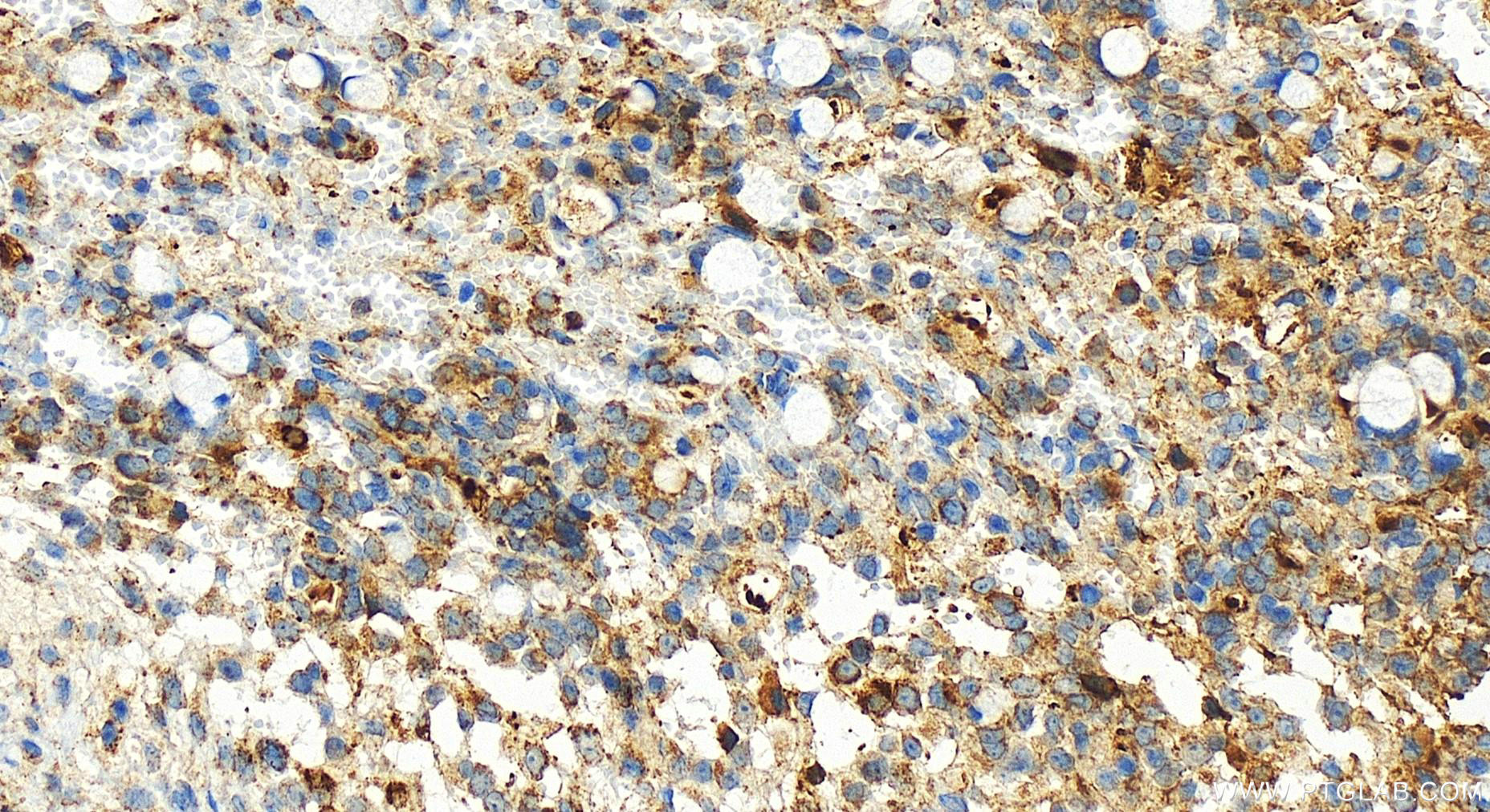 IHC staining of human ovary cancer using 83295-1-RR (same clone as 83295-1-PBS)