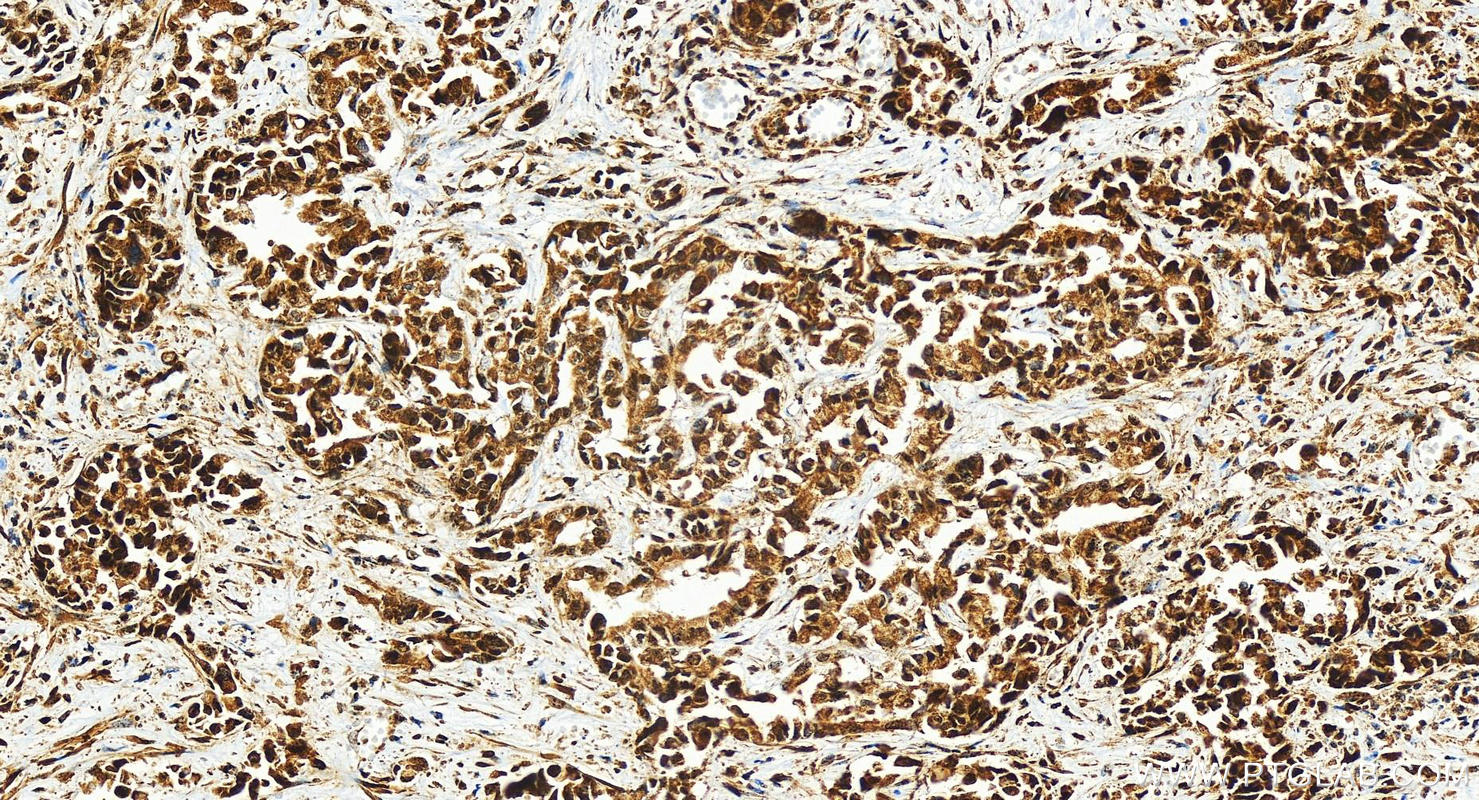 IHC staining of human intrahepatic cholangiocarcinoma using 83295-5-RR