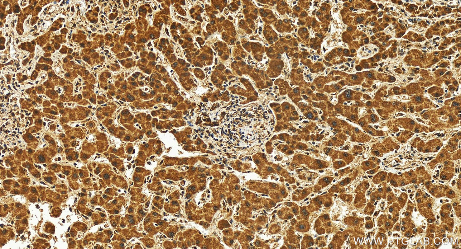IHC staining of human intrahepatic cholangiocarcinoma using 83295-5-RR