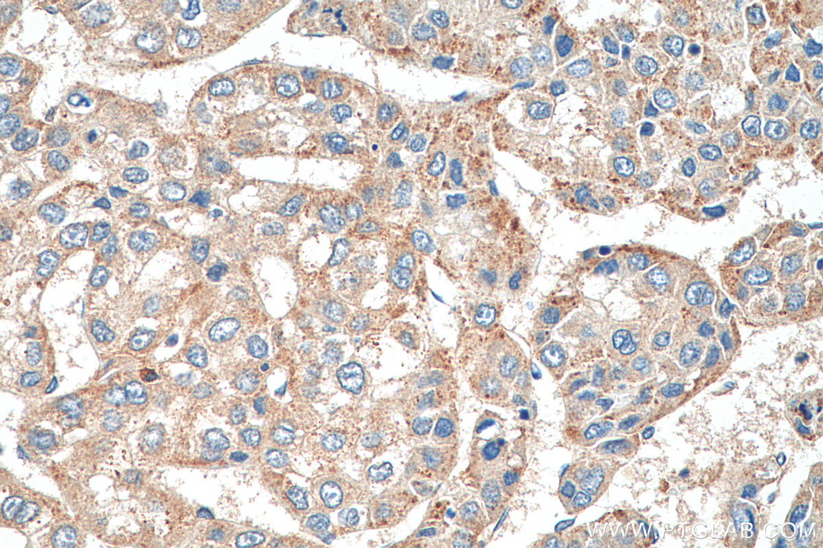 IHC staining of human liver cancer using 17737-1-AP