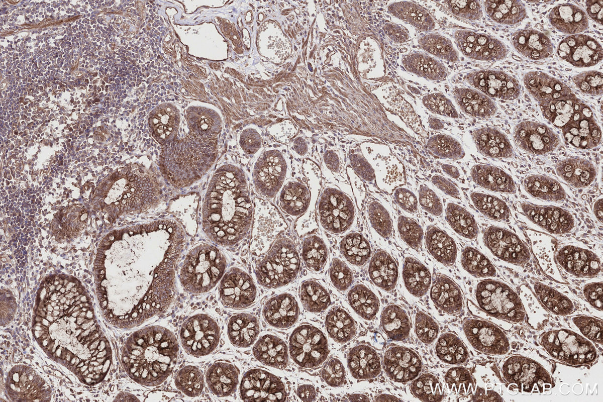 IHC staining of human rectal cancer using 26226-1-AP IHC staining of human rectal cancer using 26226-1-AP