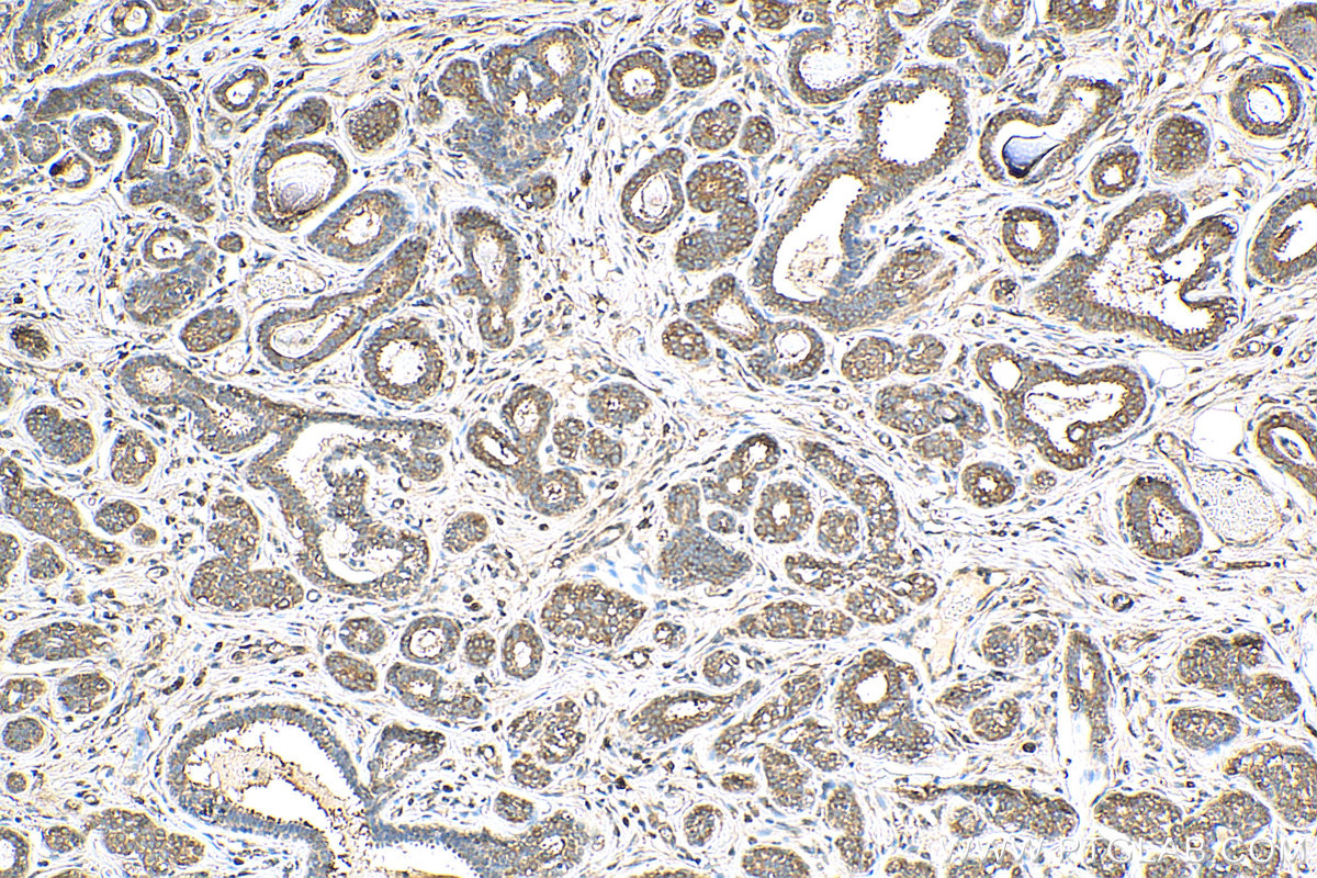 IHC staining of human breast cancer using 28347-1-AP