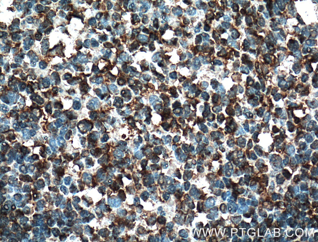 IHC staining of human tonsillitis using 16818-1-AP