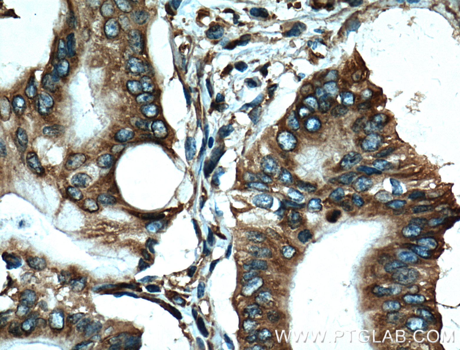 IHC staining of human pancreas cancer using 60085-1-Ig (same clone as 60085-1-PBS)