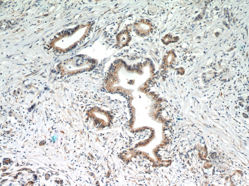 IHC staining of human pancreas cancer using 60085-2-Ig (same clone as 60085-2-PBS)