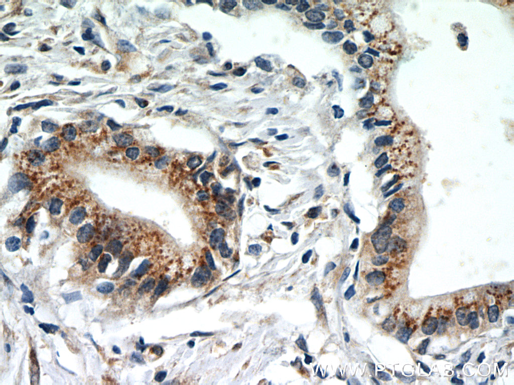 IHC staining of human pancreas cancer using 60085-2-Ig (same clone as 60085-2-PBS)