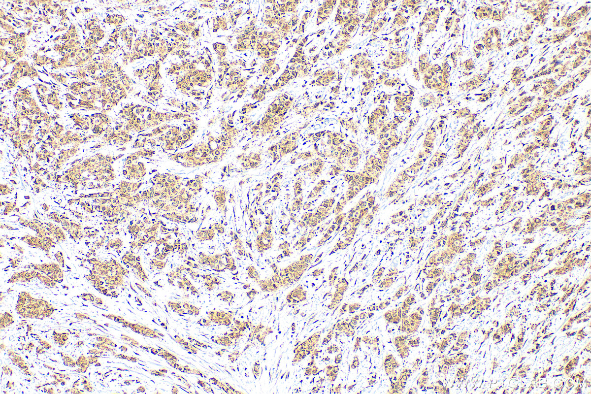 IHC staining of human breast cancer using 10805-1-AP